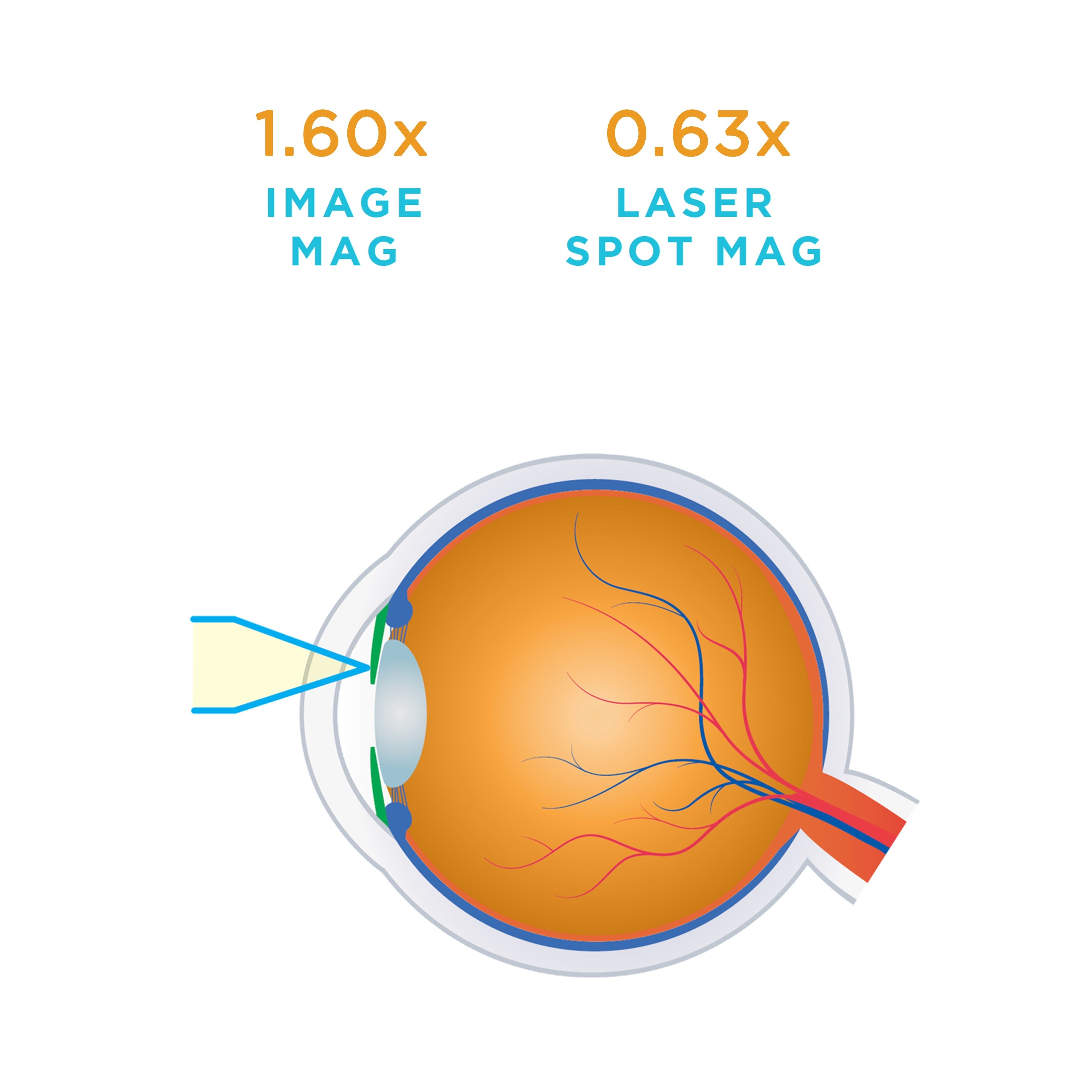 Mag Plus Iridectomy — manufacturer image