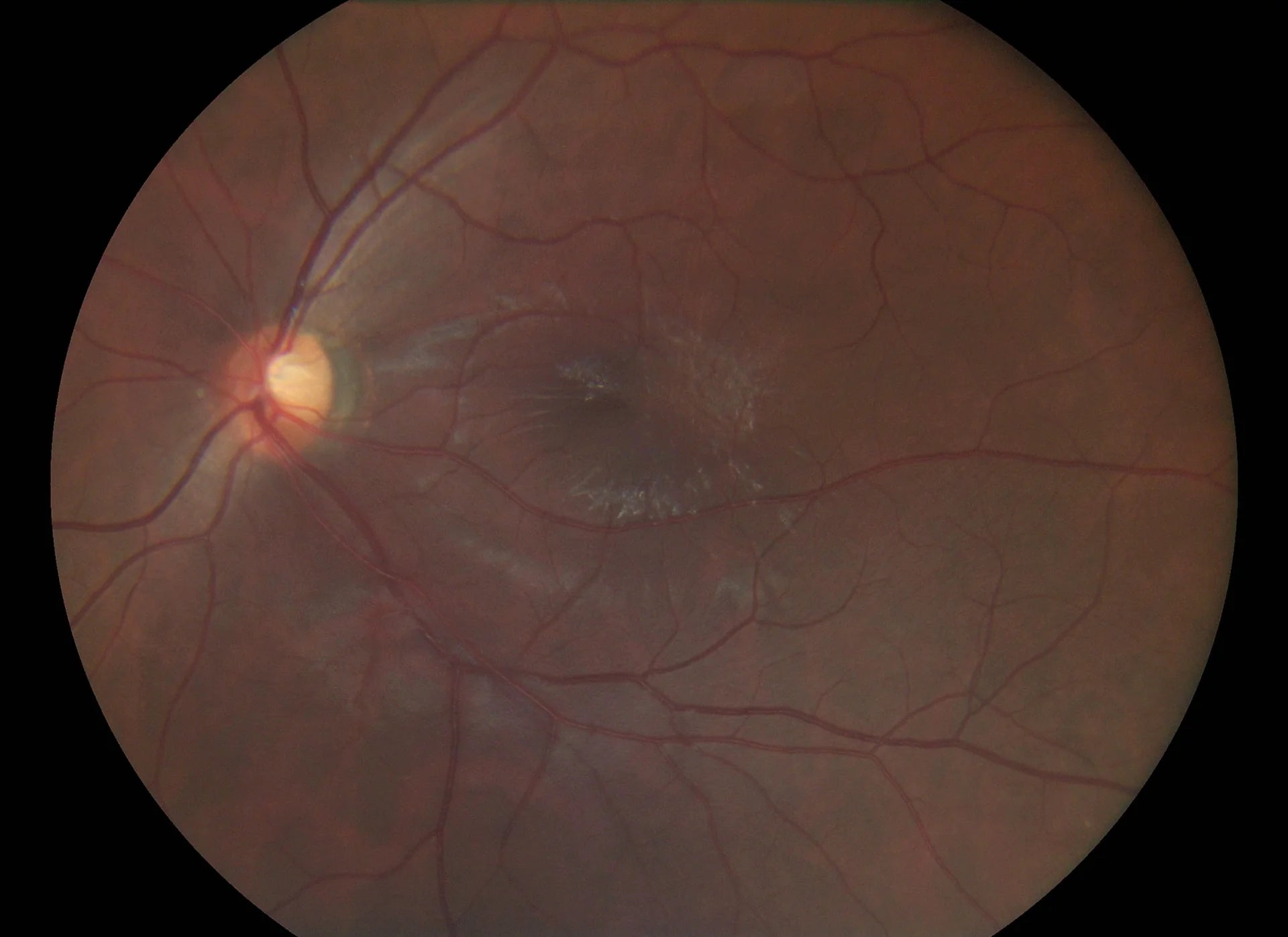 Full Opthalmic Kit (Fundus + Anterior)**