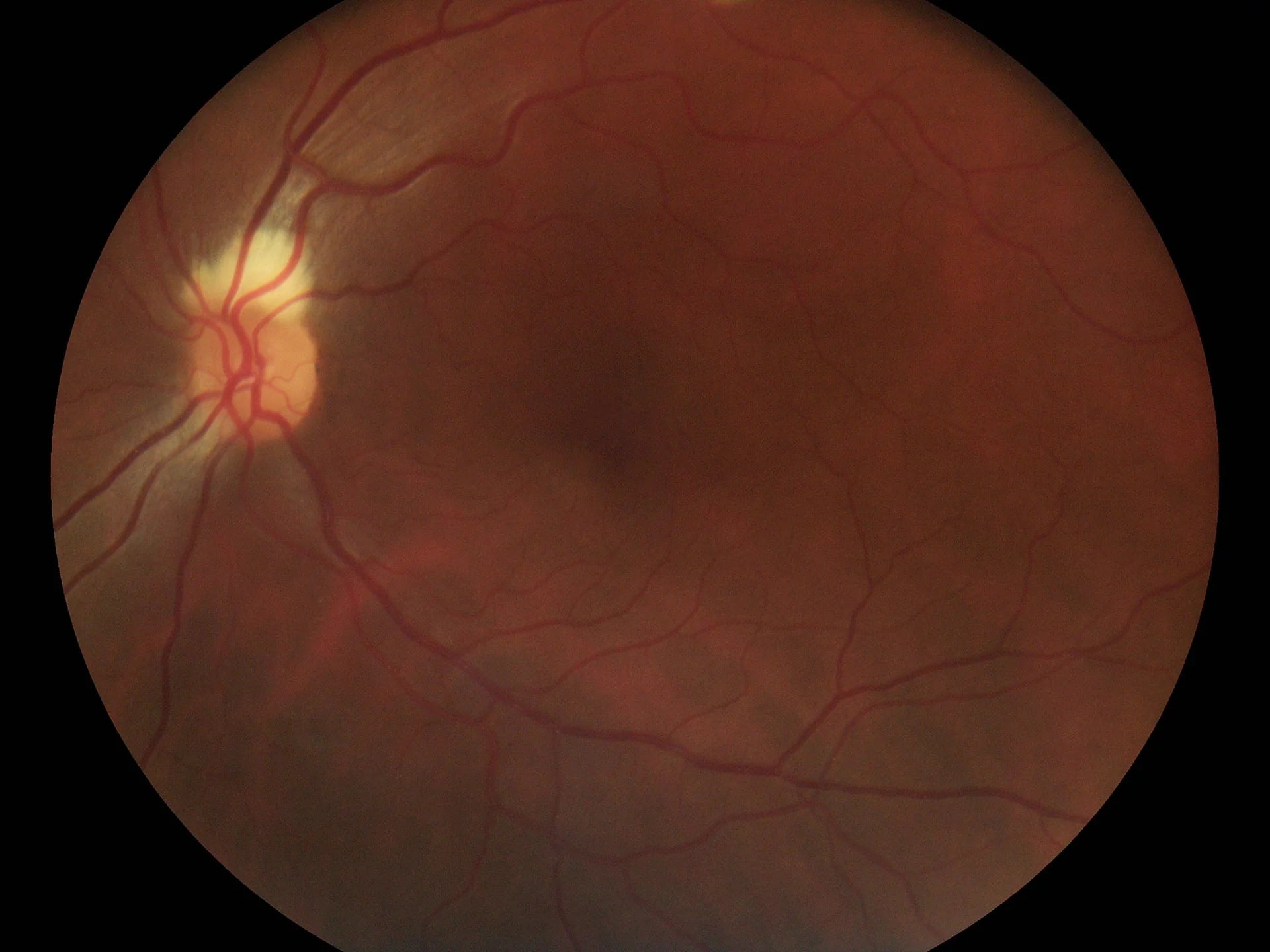 Full Opthalmic Kit (Fundus + Anterior)**