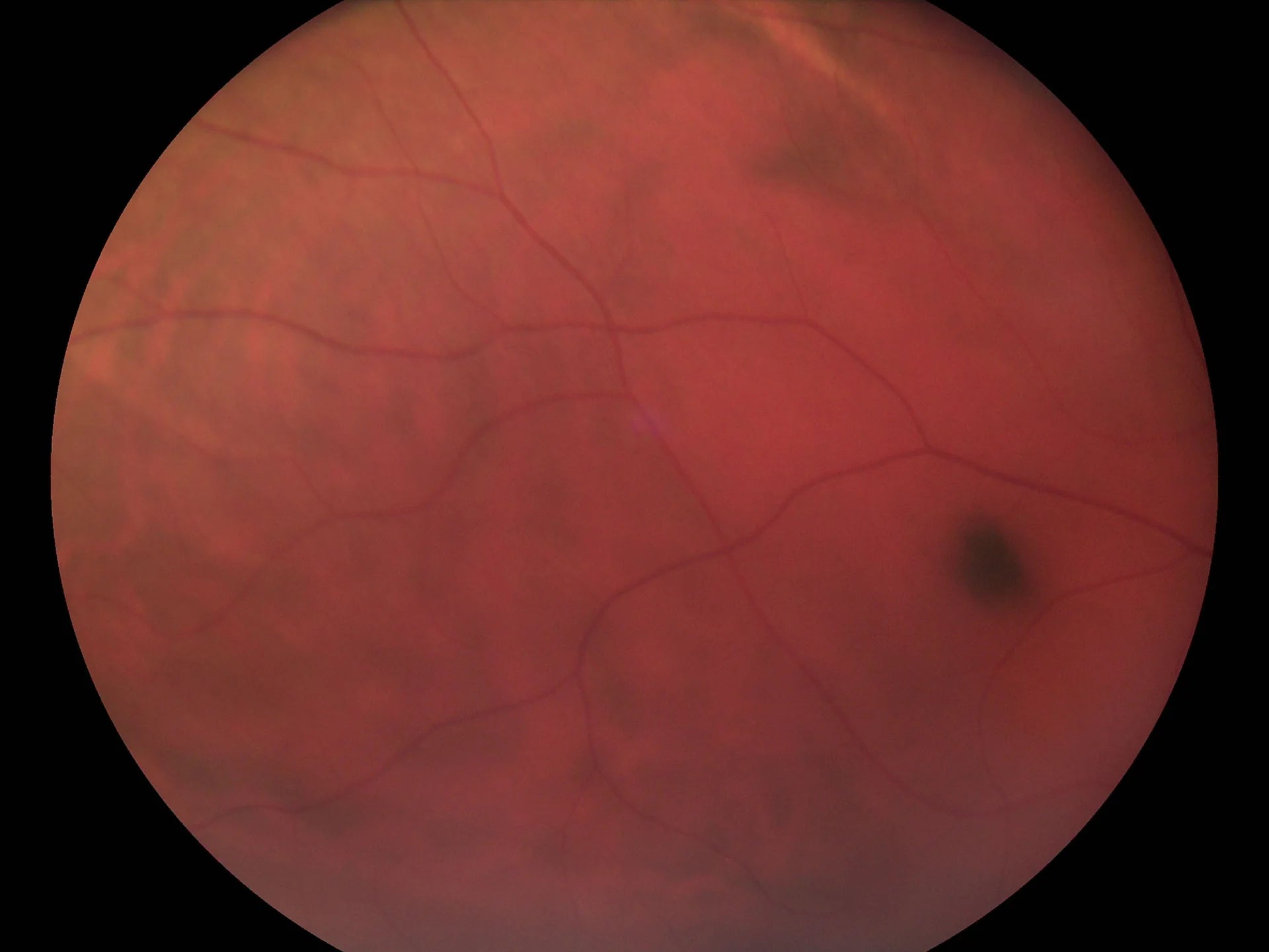 Full Opthalmic Kit (Fundus + Anterior)**