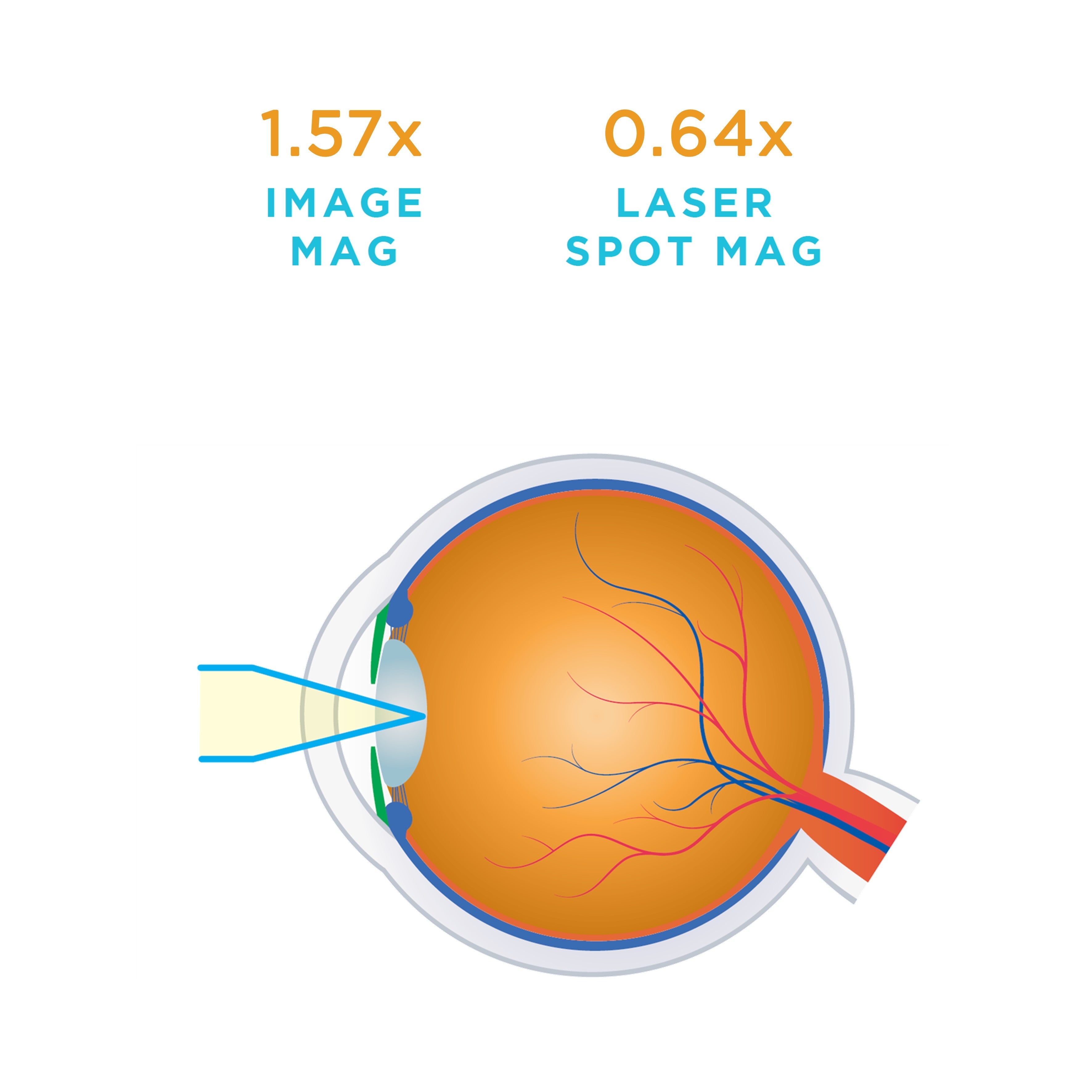 Capsulotomy — manufacturer image
