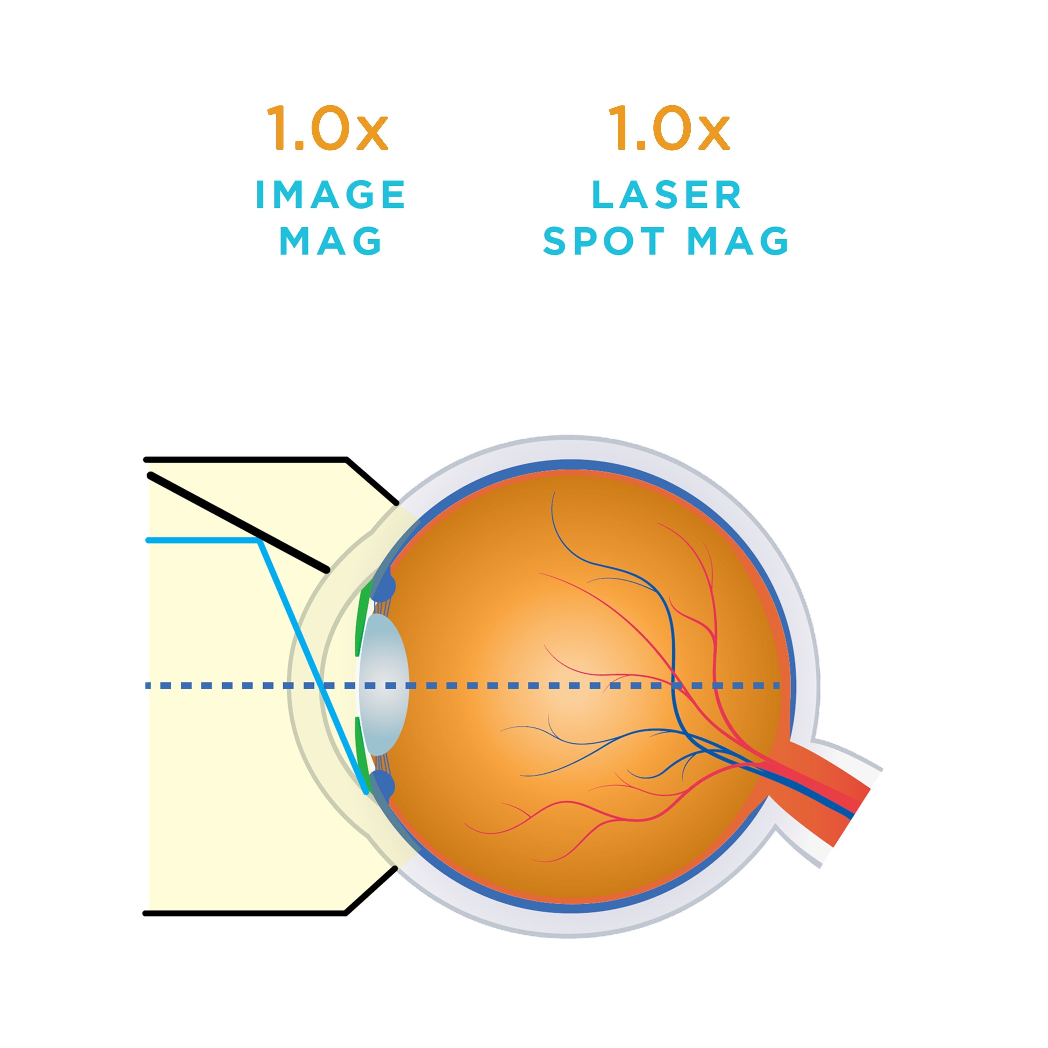 SLT (Selective Laser Trabeculoplasty) — manufacturer image
