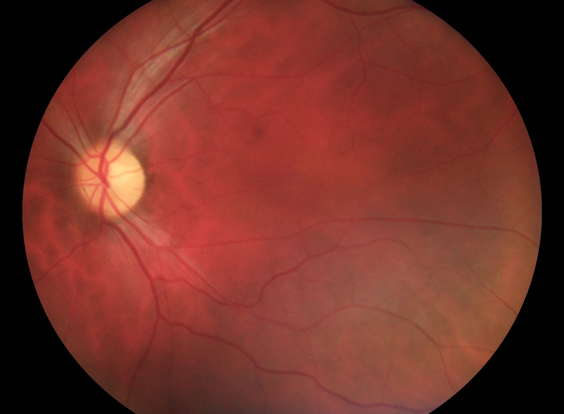 Full Opthalmic Kit (Fundus + Anterior)**